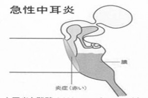 急性中耳炎状態