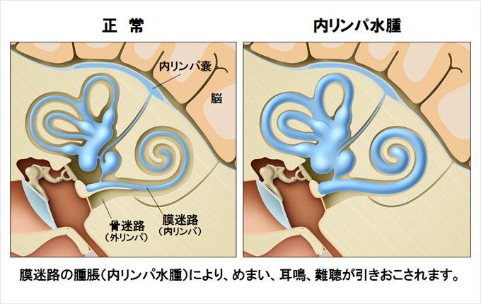 は メニエール 病 と メニエール病：やさしい耳鼻咽喉科講座：日本耳鼻咽喉科学会広島県地方部会