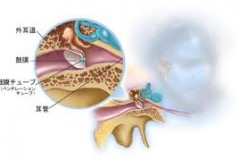 鼓膜換気チューブ～medtronicより～